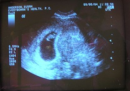 Bean ultrasound picture